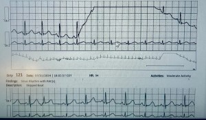 An electrocardiogram (ECG) displayed on a monitor, showing heart rhythms with varying patterns, indicating heart activity and abnormalities.