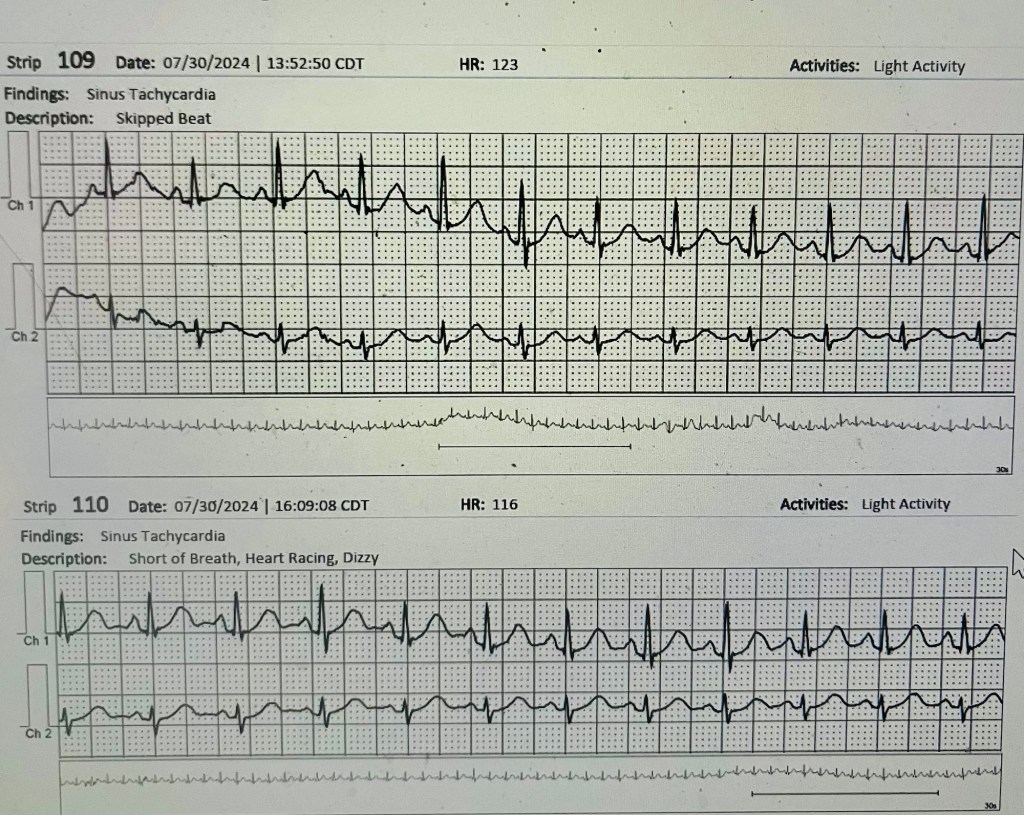 A medical report displaying two ECG strips showing sinustachycardia, with annotations on heart rate and findings.