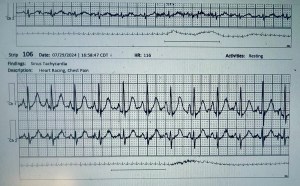 An electrocardiogram (ECG) displaying a case of supraventricular tachycardia, showing rapid heart rhythms and associated heart pain.