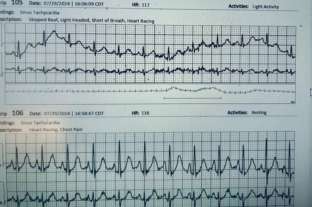 Electrocardiogram (ECG) readings showing sinus tachycardia with descriptions of heart conditions.