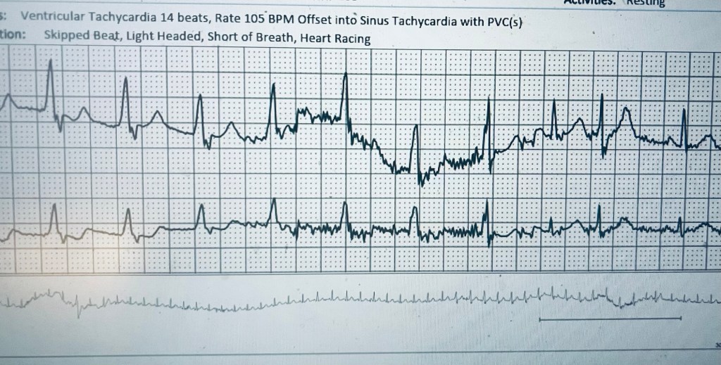 An electrocardiogram (ECG) showing patterns characteristic of ventricular tachycardia and sinus tachycardia, with notes indicating symptoms like skipped beats and shortness of breath.