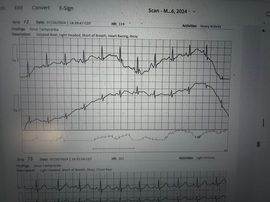 ECG report showing sinus tachycardia with highlighted heart rates and activity notes.