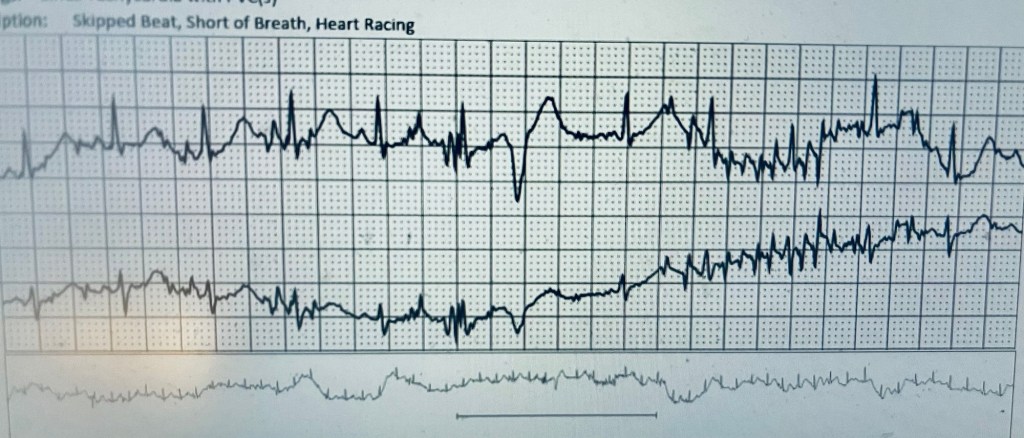 An electrocardiogram (ECG) tracing showing irregular heartbeats, indicating episodes of tachycardia and skipped beats.