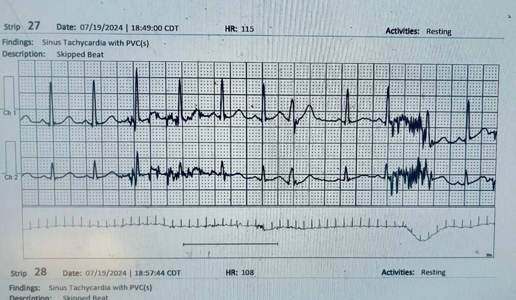 An electrocardiogram (ECG) strip showing sinus tachycardia with skipped beats, displayed over multiple channels with corresponding heart rates.